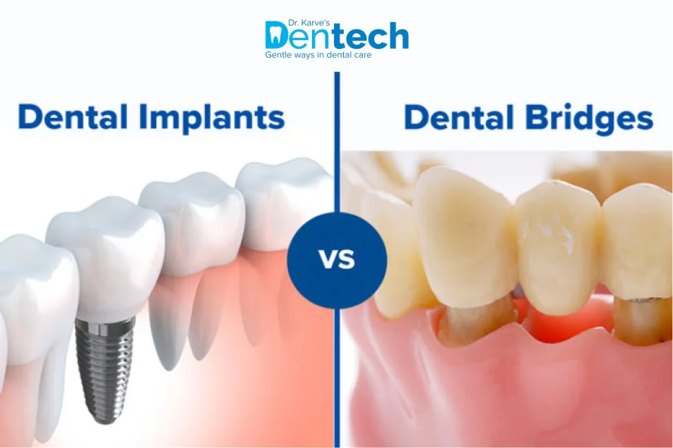 Crown Bridges vs Tooth Implants